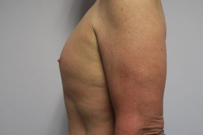 MTF Breast Augmentation