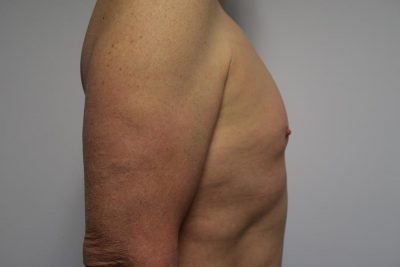 MTF Breast Augmentation