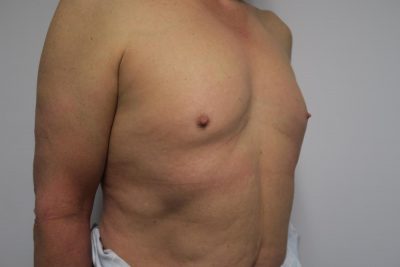 MTF Breast Augmentation