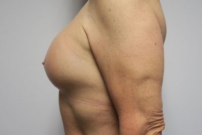 MTF Breast Augmentation