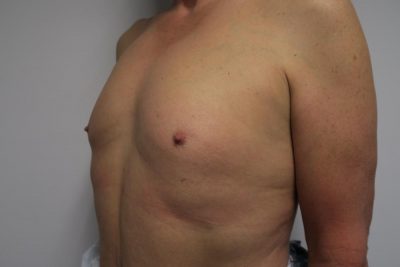 MTF Breast Augmentation
