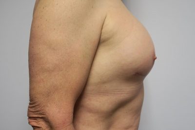 MTF Breast Augmentation