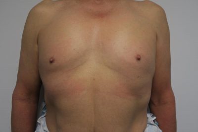MTF Breast Augmentation