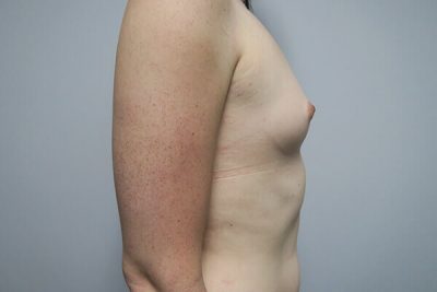 MTF Breast Augmentation