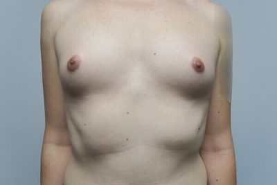 MTF Breast Augmentation