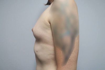 MTF Breast Augmentation