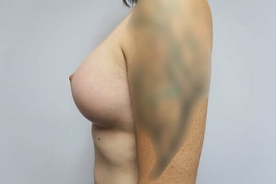 MTF Breast Augmentation