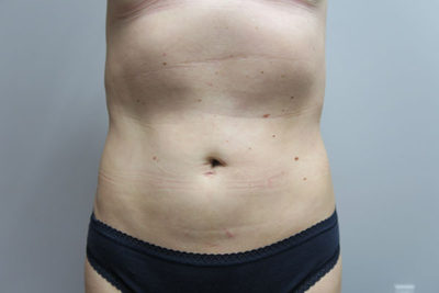 Liposuction