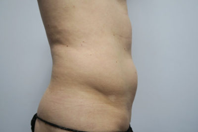 Liposuction