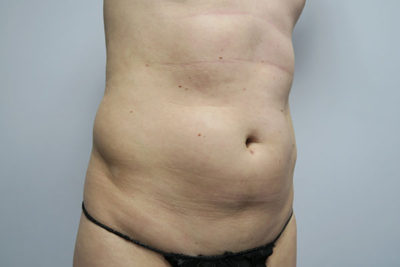 Liposuction