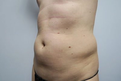 Liposuction