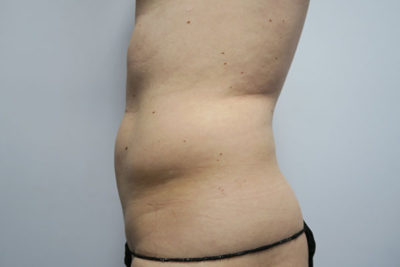 Liposuction