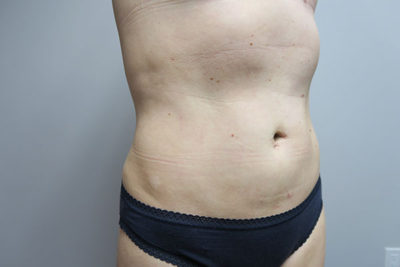Liposuction