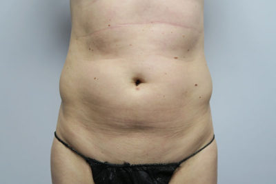 Liposuction