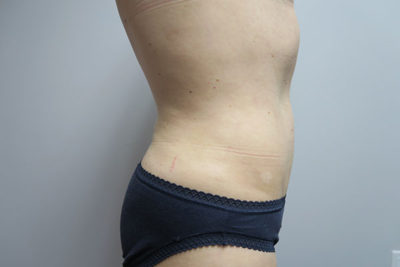 Liposuction