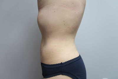 Liposuction