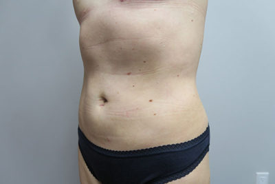 Liposuction