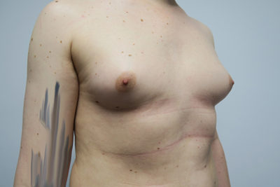 MTF Breast Augmentation
