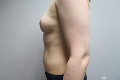 MTF Breast Augmentation