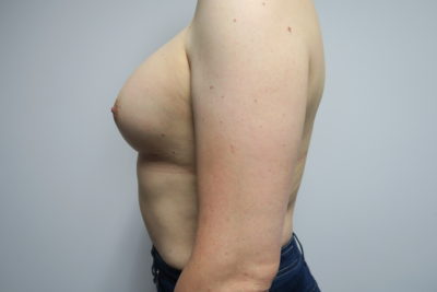 Breast Procedures