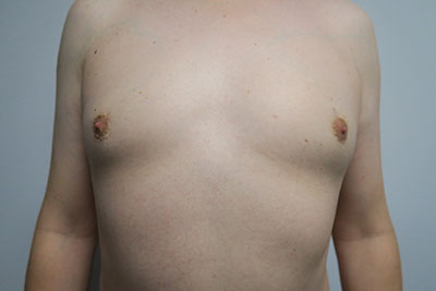 Breast Procedures