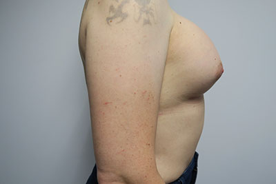 Breast Procedures