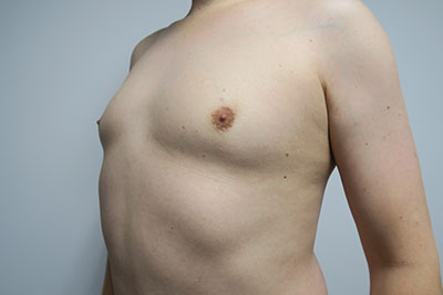 Breast Procedures