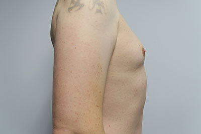 Breast Procedures