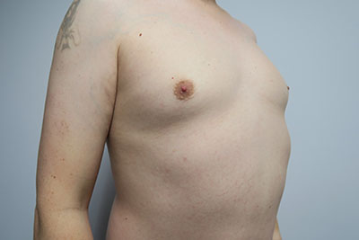 Breast Procedures