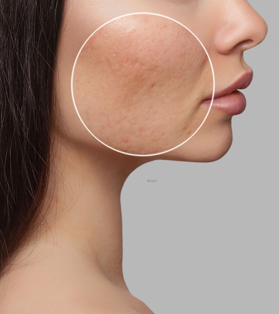 Hidradenitis Suppurativa Treatment