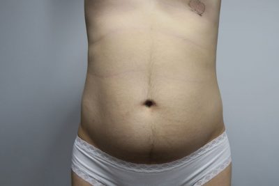 Liposuction
