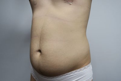 Liposuction