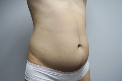 Liposuction