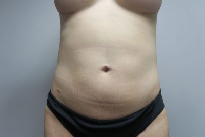 Liposuction