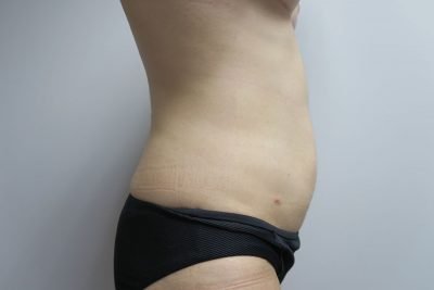 Liposuction