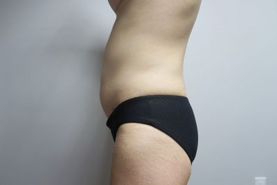 Liposuction
