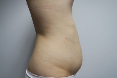 Liposuction