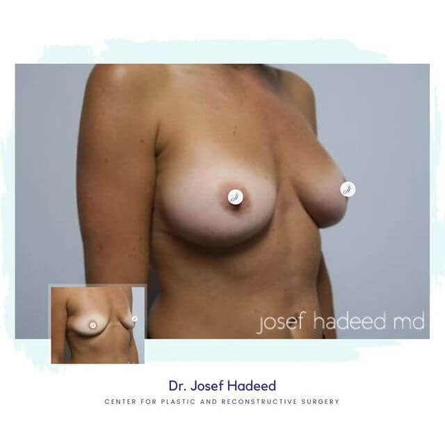 Before and After, Breast Augmentation
