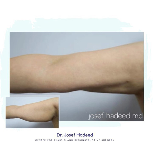 Before and After Arm Lift Hadeed Plastic Surgery