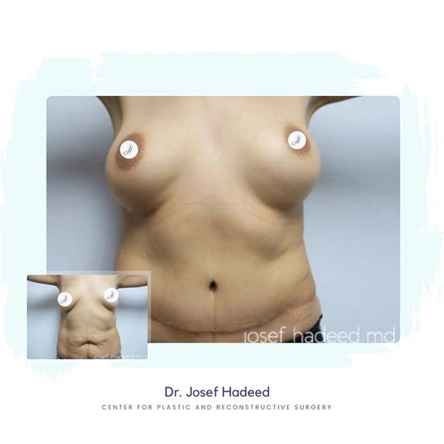 Before and After Mommy Makeover Hadeed Plastic Surgery