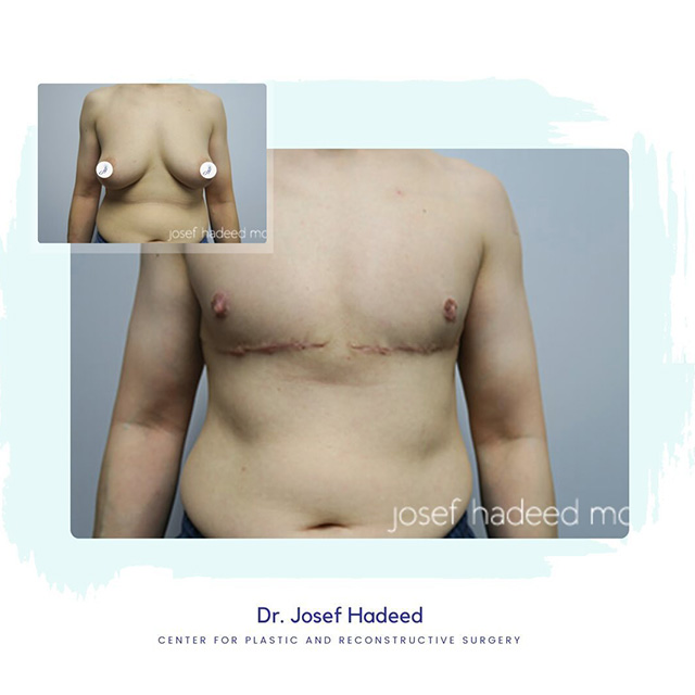 Before and After Top Surgery FTM Hadeed Plastic Surgery