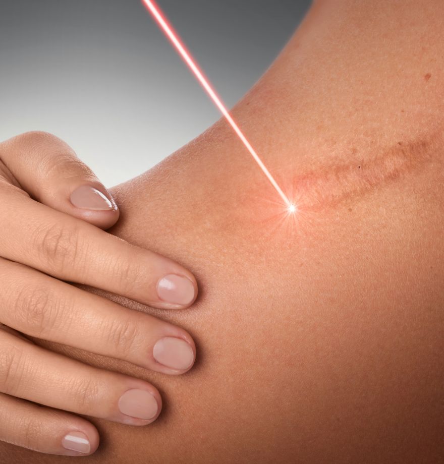 laser treatment on a scar