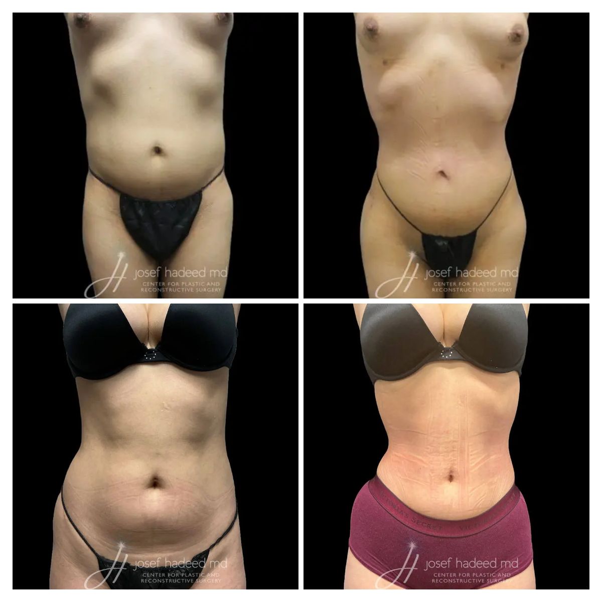 h-curve Before and after case - josef hadeed, md miami florida