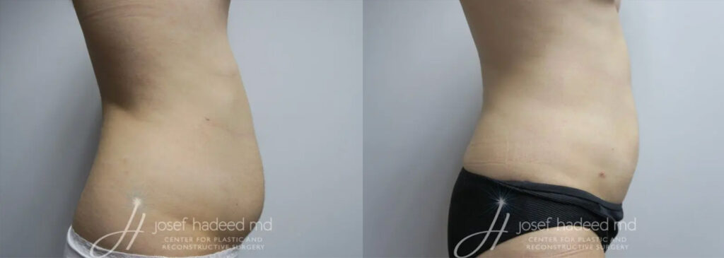 patient liposuction before and after