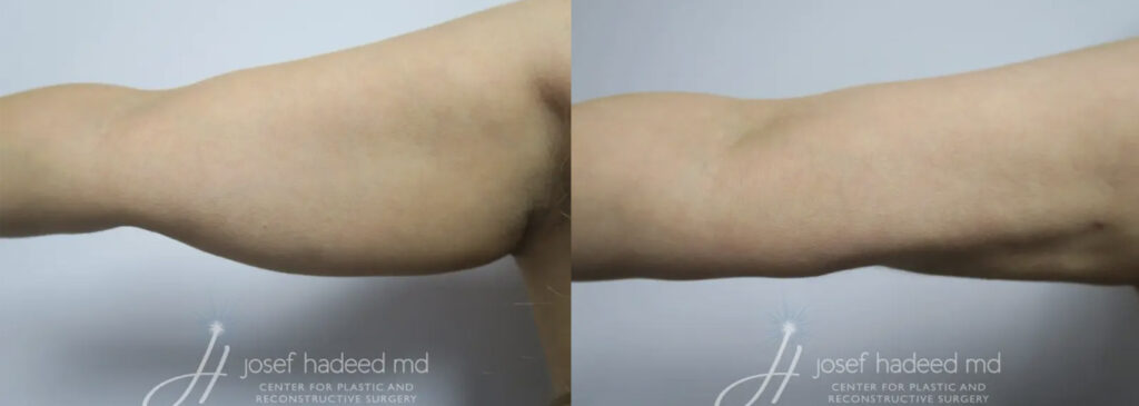 arm liposuction before and after