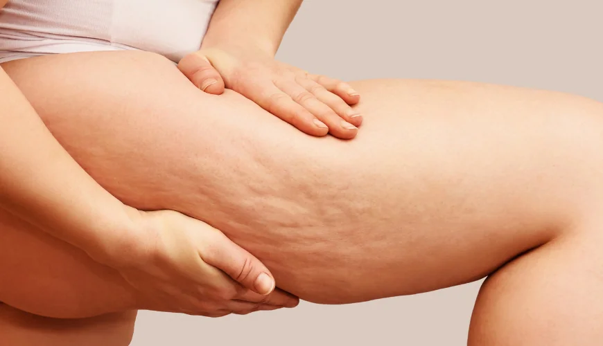 Close-up of a woman's thighs showing disproportionate lower body fat associated with lipedema vs. weight gain.