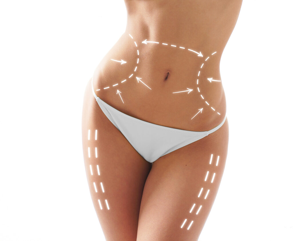 Illustration showing body contouring surgery preparation with treatment markings before a body contouring procedure