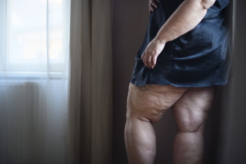 lipedema Diagnosed