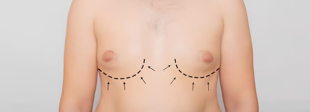 Gynecomastia Surgery