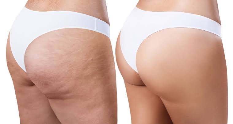 How to Treat Lipedema before and after treatment results showing smoother skin and improved leg contours